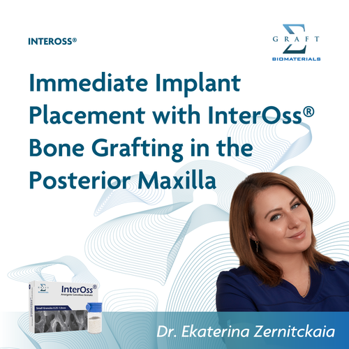 Immediate implant placement with InterOss bone grafting in the posterior maxilla, by Dr. Ekaterina Zernitckaia (PDF, opens in a new tab)