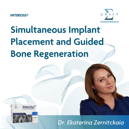 Simultaneous implant placement and guided bone regeneration, by Dr. Ekaterina Zernitckaia (PDF, opens in a new tab)