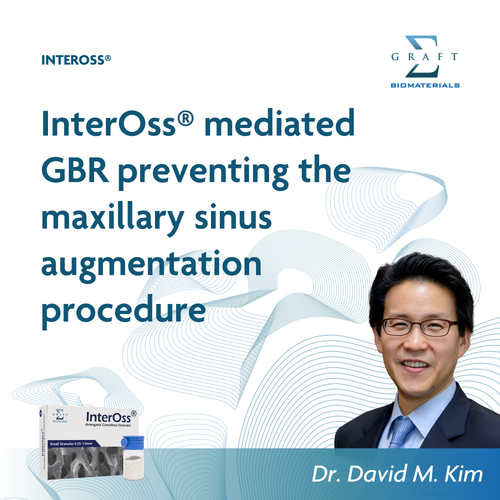 InterOss mediated GBR preventing the maxillary sinus augmentation procedure, by Dr. David M. Kim (PDF, opens in a new tab)