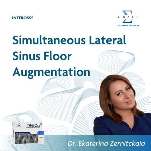 Simultaneous lateral sinus floor augmentation, by Dr. Ekaterina Zernitckaia (PDF, opens in a new tab)
