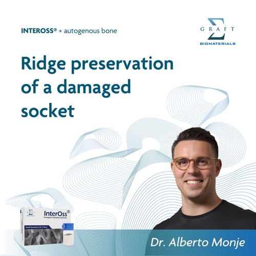 Ridge preservation of a damaged socket, by Dr. Alberto Monje (PDF, opens in a new tab)