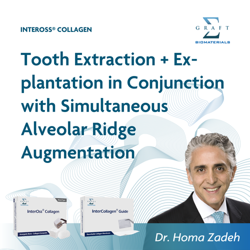 Tooth extraction and explantation with simultaneous alveolar ridge augmentation, by Dr. Homa Zadeh (PDF, opens in a new tab)