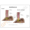 Esophageal Reflux Description Card