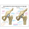 Arthritic Hip ,4-Stage Model Description Card