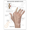 Hand Rheumatoid Arthritis Anatomical Model Description Card