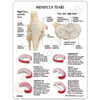 Knee Anatomical Meniscus Tear Model description Card