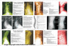 Cervical and Lumbar Degeneration Poster