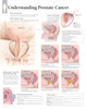 Prostate Cancer Poster