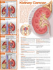 Kidney Cancer Poster