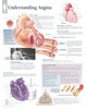 Understanding Angina Anatomical Poster