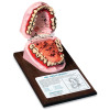 Tobacco Mouth Model