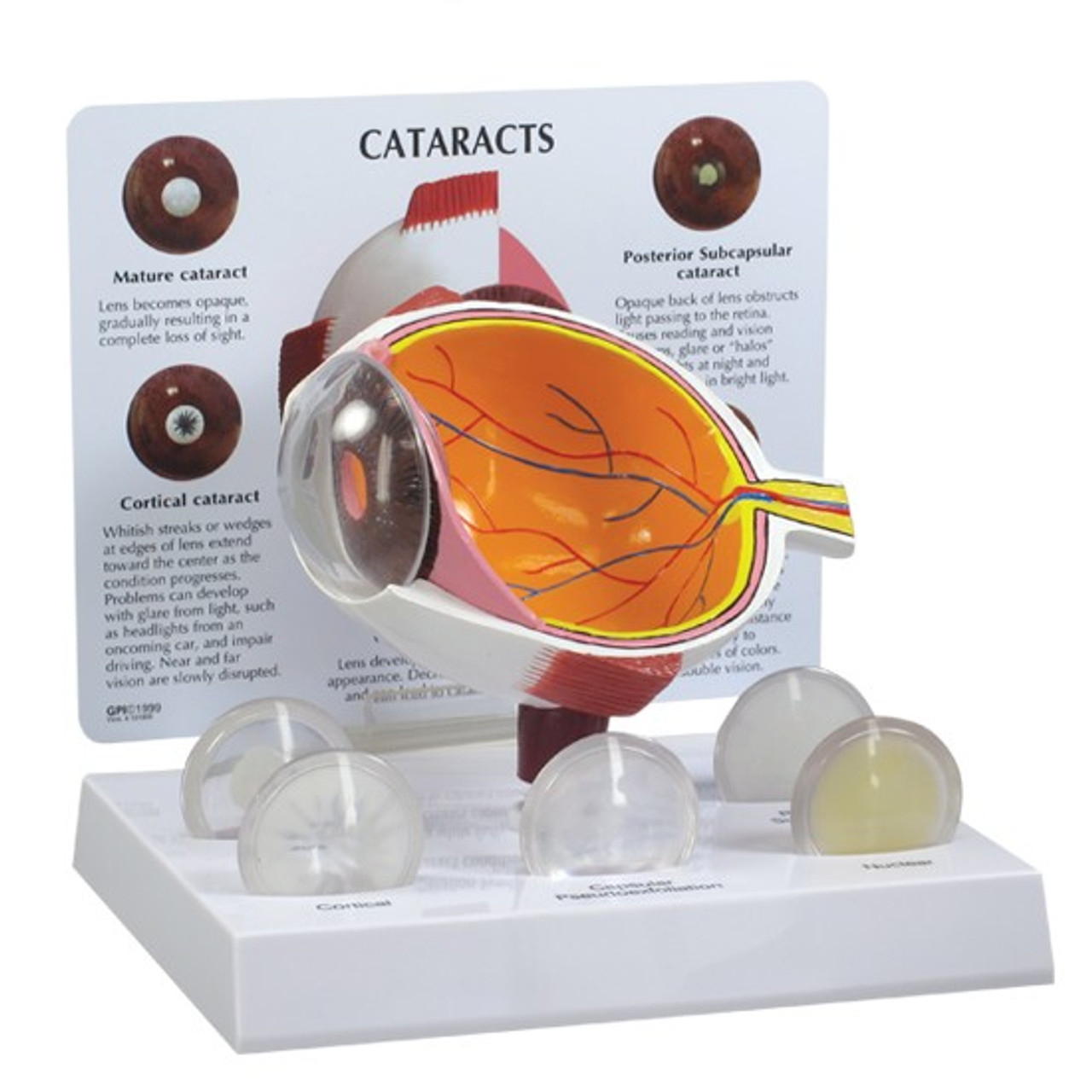 Cataract Eye Model