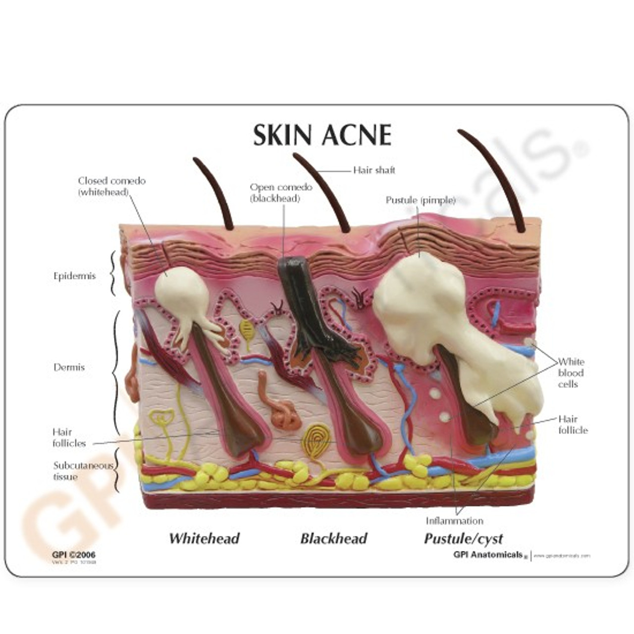 Acne Skin Model Description Card