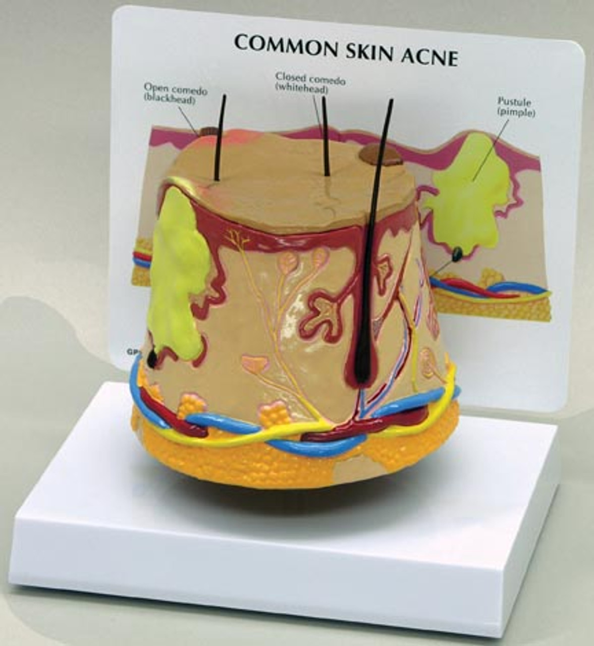 Skin Acne Anatomical Model