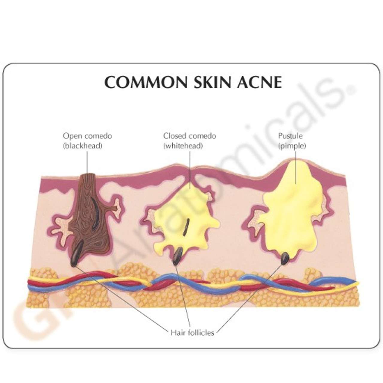Pimple Under Skin Diagram