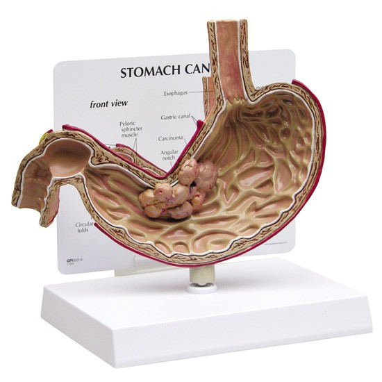Stomach Cancer Anatomical Model - Clinical Charts and Supplies