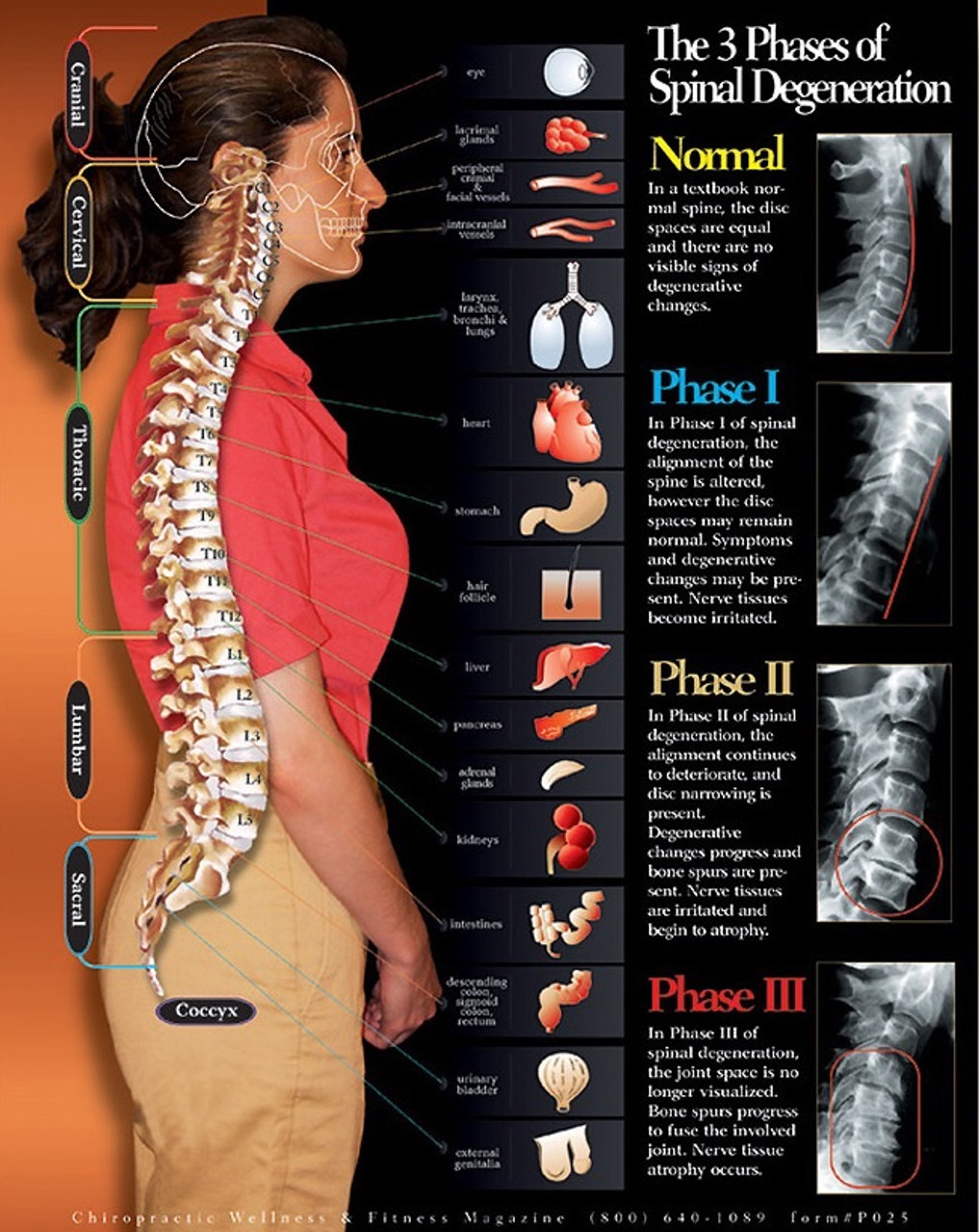 3 Phases Of Spinal Degeneration Chiropractic Chart Clinical Charts