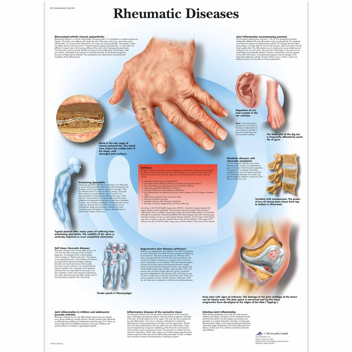 Rheumatic Diseases Anatomy Poster