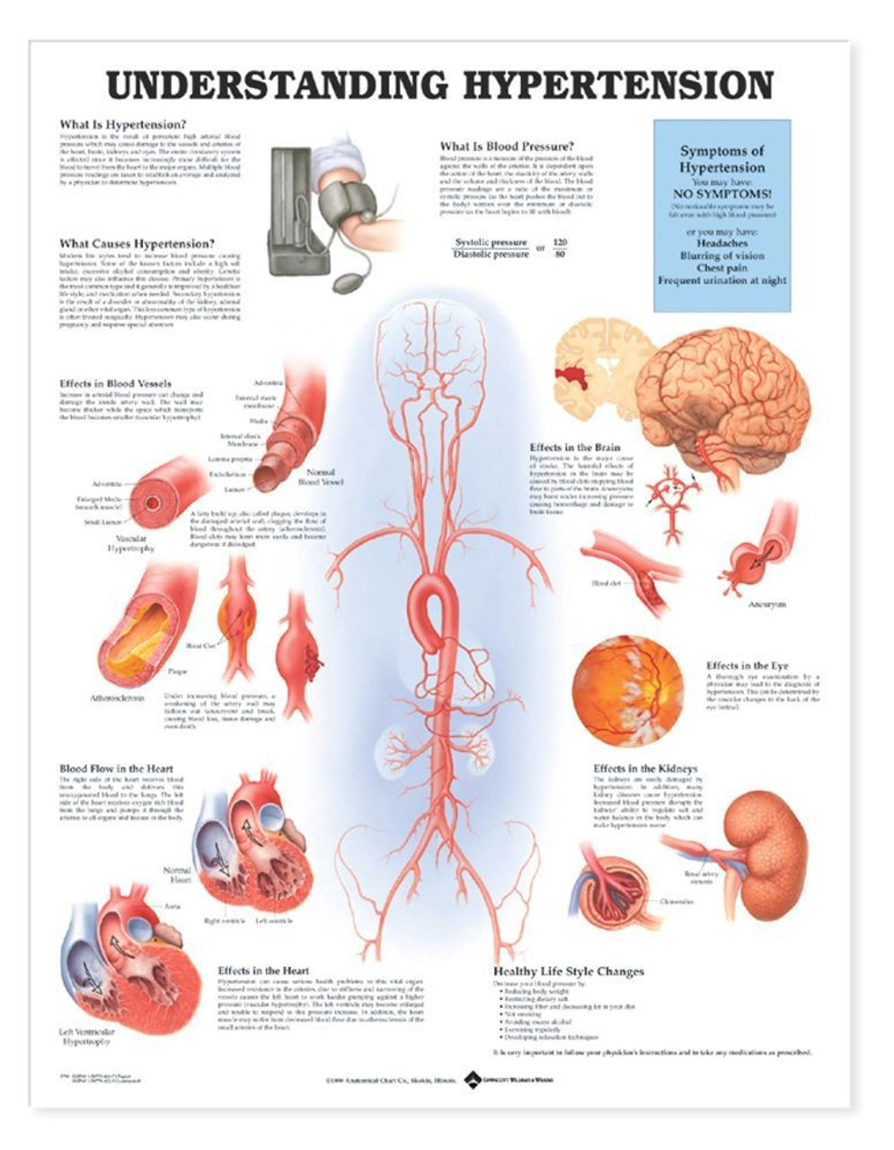 Hypertension Anatomy Poster