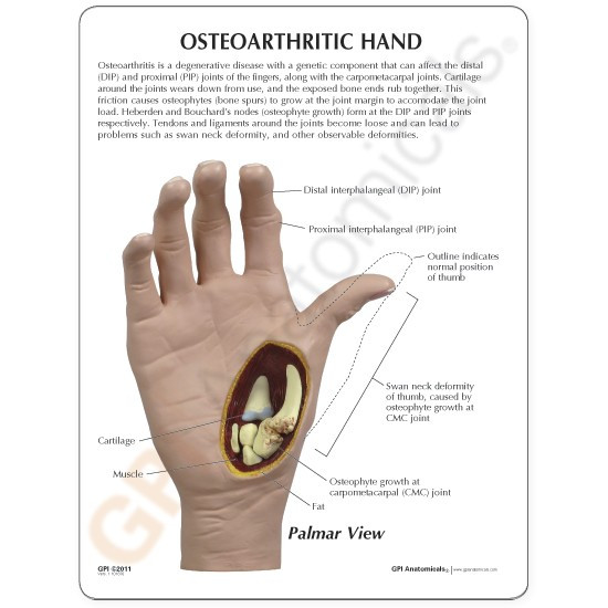 Hand And Finger Osteoarthritis Model Clinical Charts and Supplies