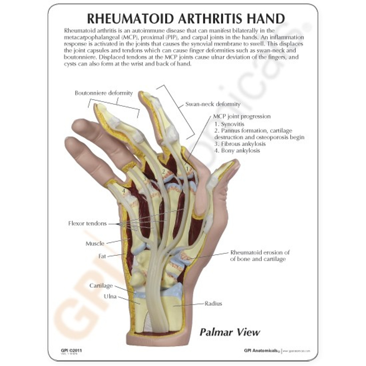 健康・医学 A Colour Atlas of Rheumatoid Hand Rheumatoid Arthritis (RA)