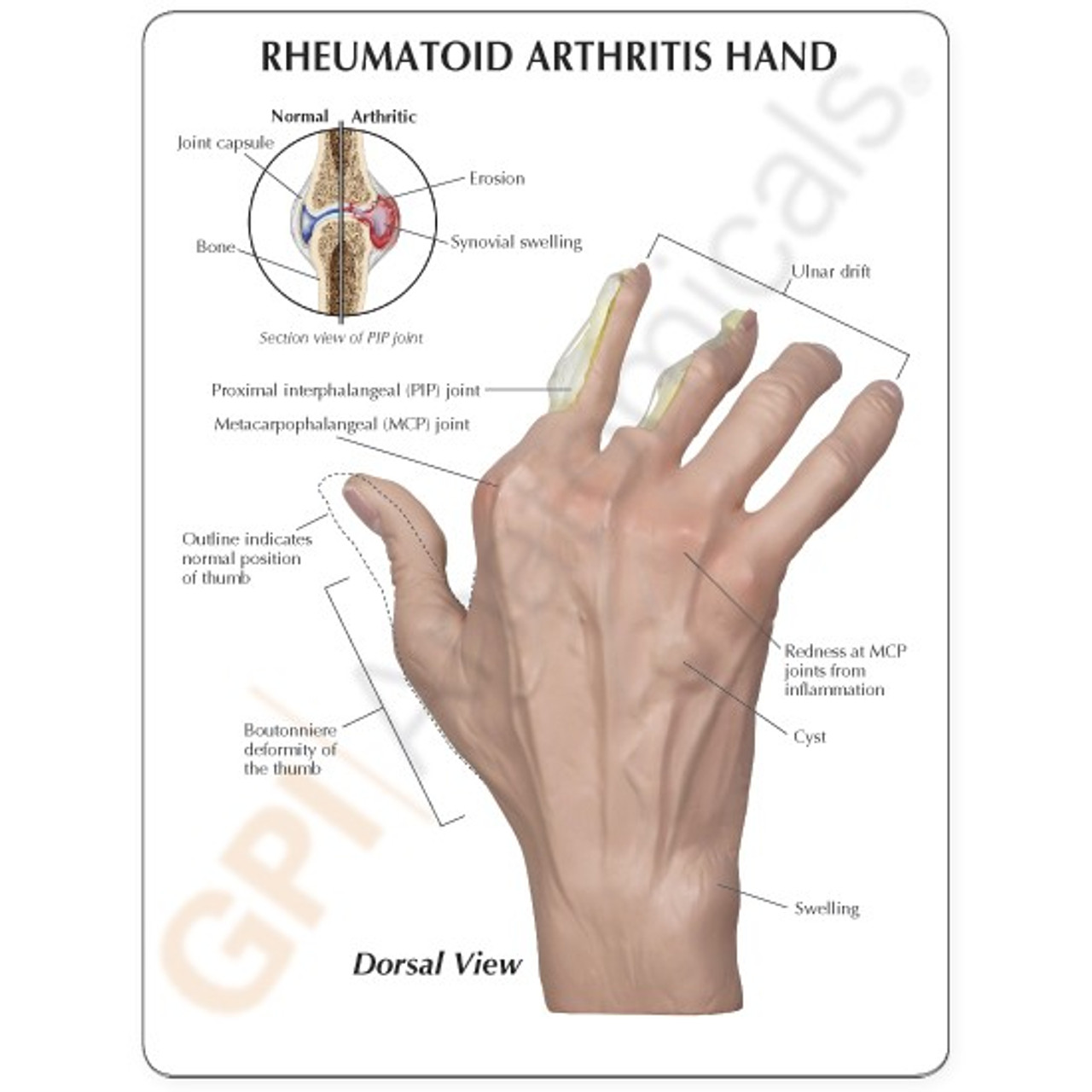 Hand Rheumatoid Arthritis Model - Clinical Charts and Supplies