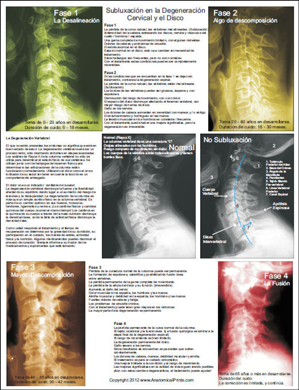 Cervical Spine Subluxation Degeneration in Spanish