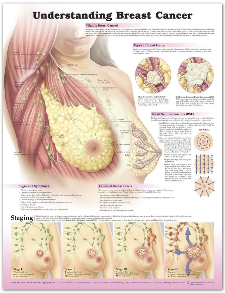 語学+参考書 CANCER BOARD of the BREAST (Vol.3 No.2(2017 8)) Understanding Breast Cancer 3rd Ed Poster - Clinical Charts and