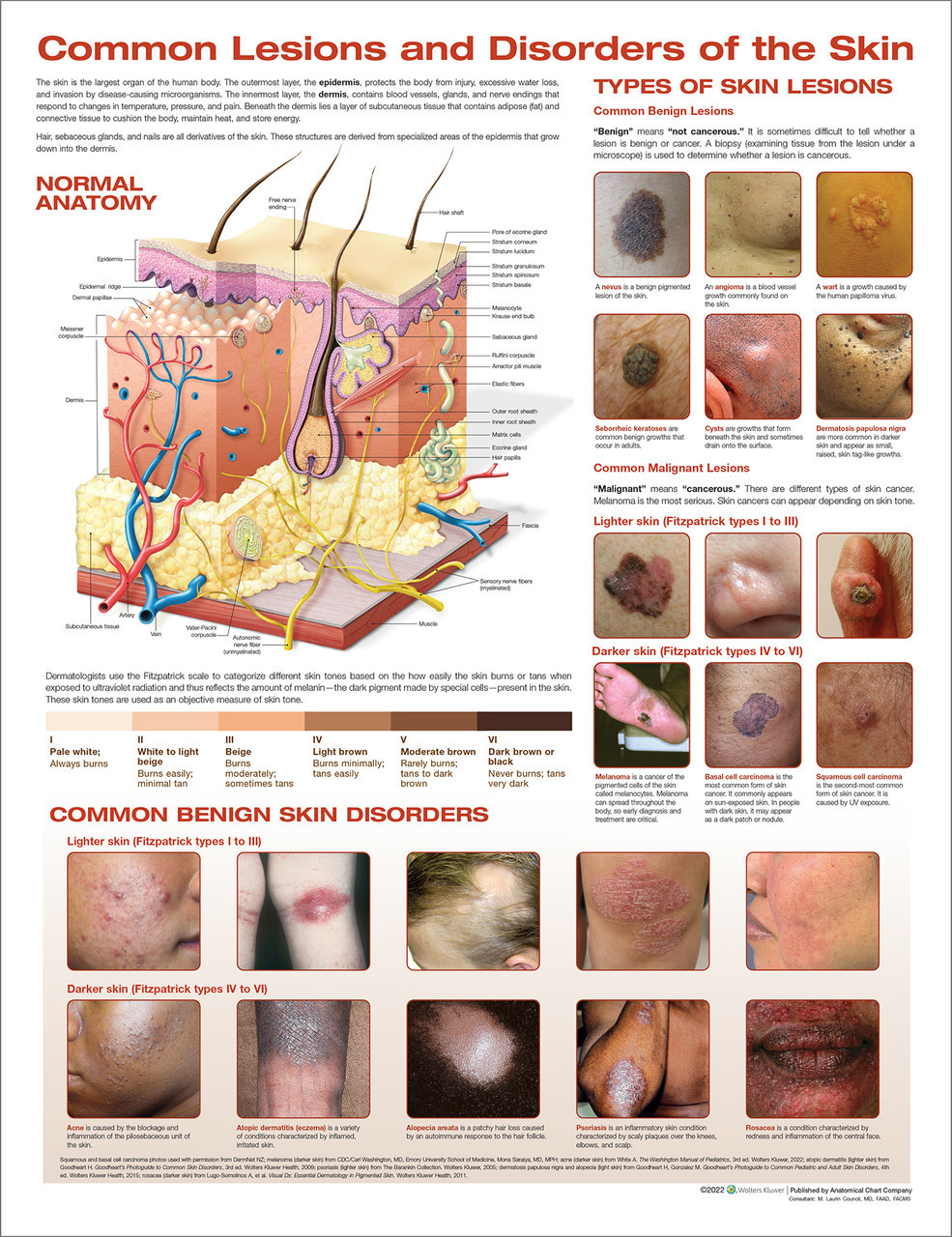 benign skin lesions