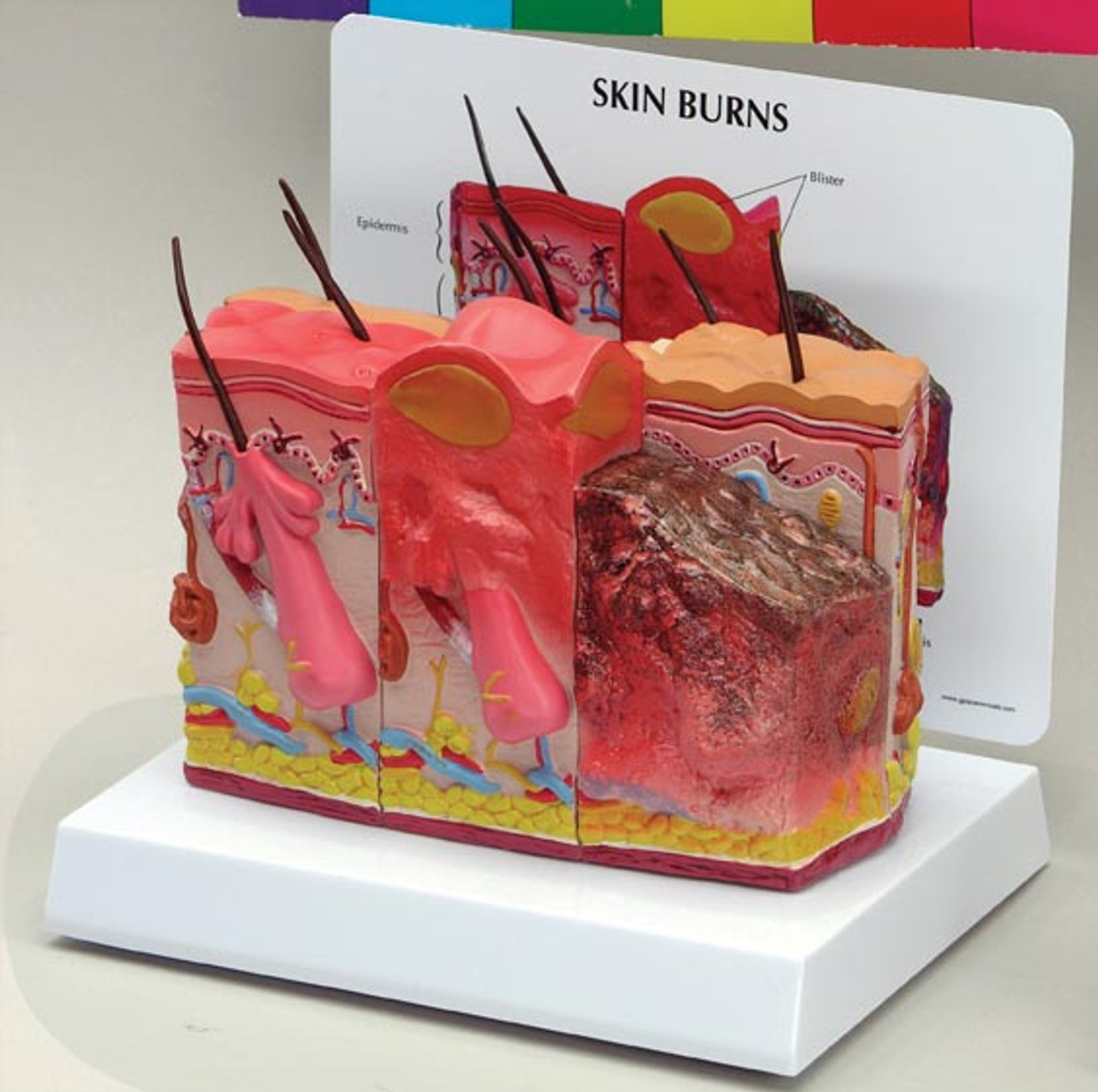 Skin Burn & Normal Skin Anatomical Model