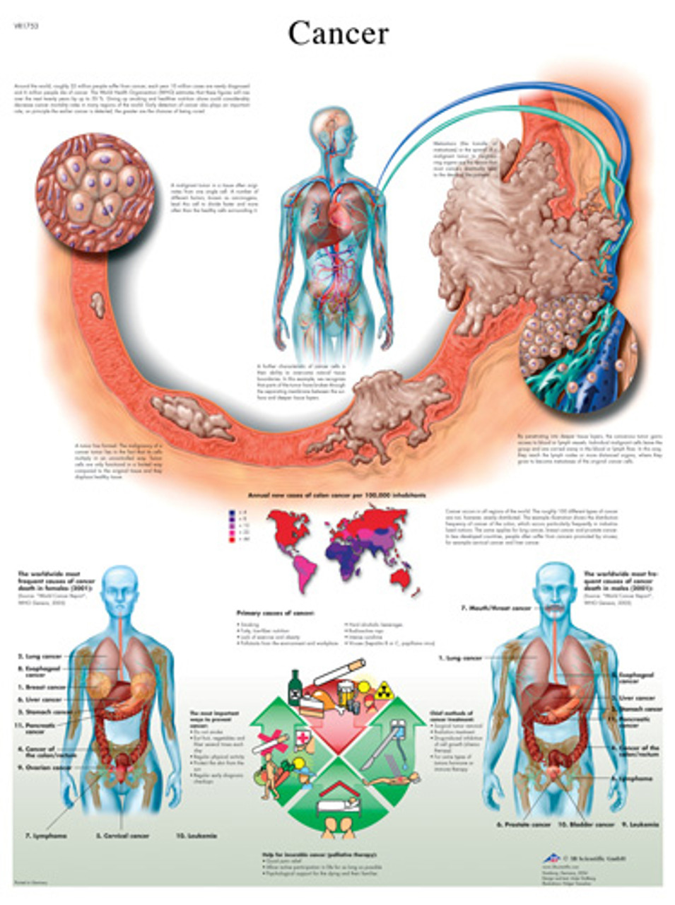 Cancer Anatomical Chart