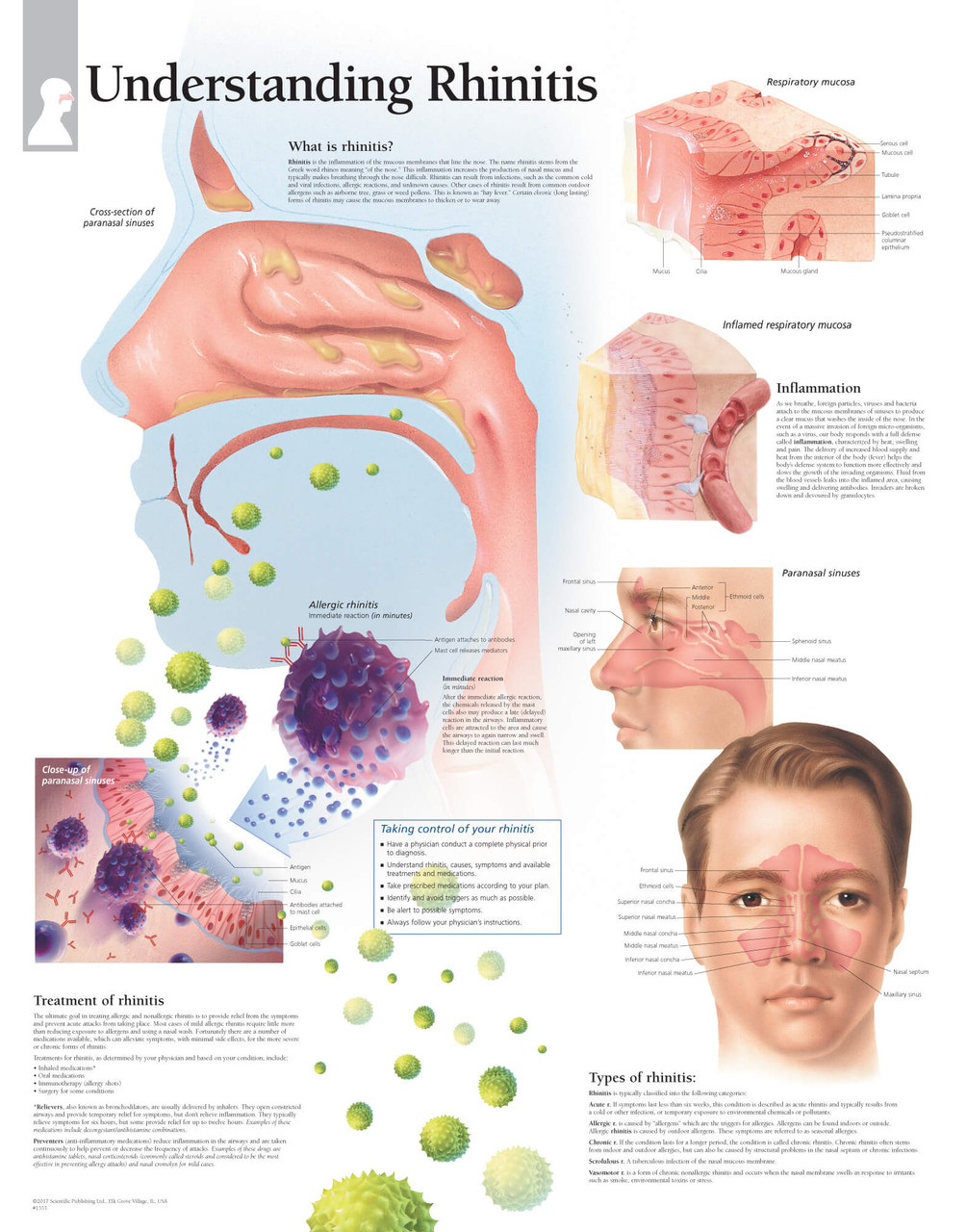 Understanding Rhinitis Anatomy Poster