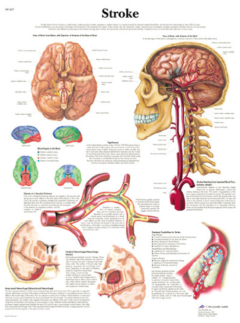 Stroke Chart