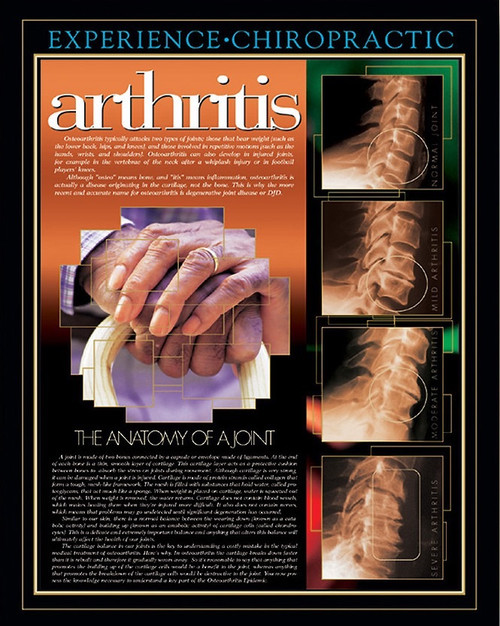 健康・医学 A Colour Atlas of Rheumatoid Hand Hand Rheumatoid Arthritis RA Anatomical Model