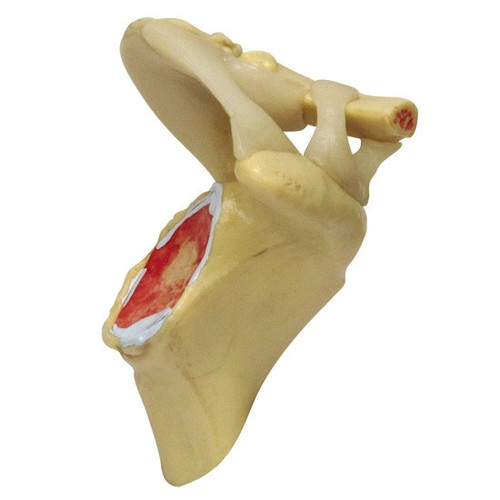 Shoulder Osteoarthritis Anatomical Model