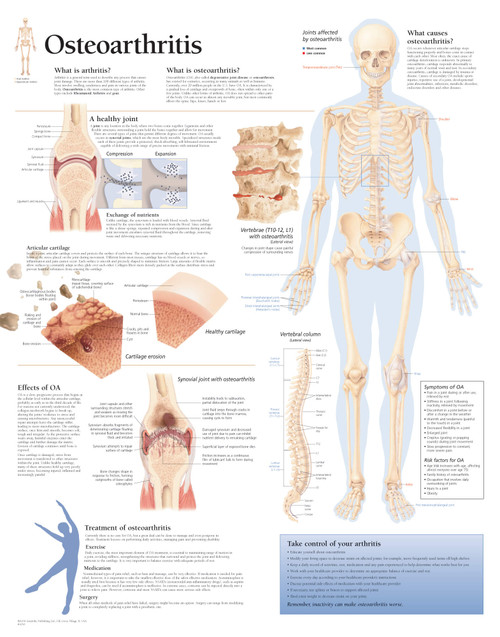 Osteoarthritis Anatomy Chart