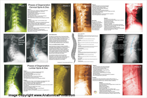 Cervical and Lumbar Degeneration Poster Cervical and Lumbar Degeneration Poster