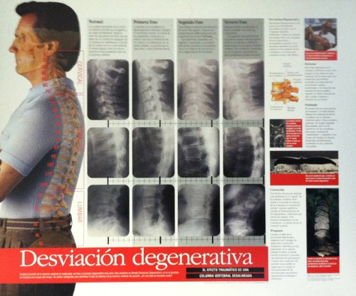 Spinal Degeneration in Spanish