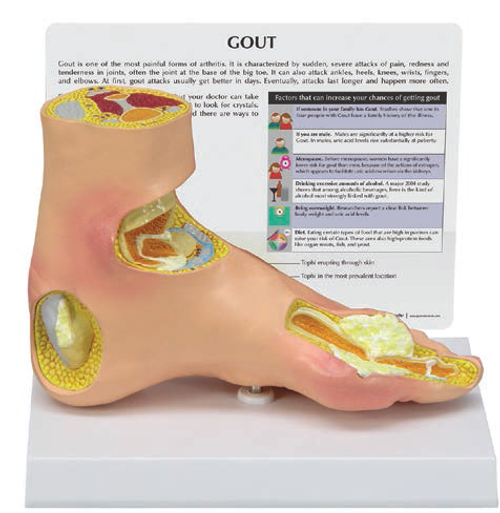 Gout Arthritis Foot Model