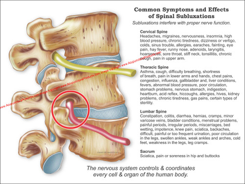 Subluxation Poster