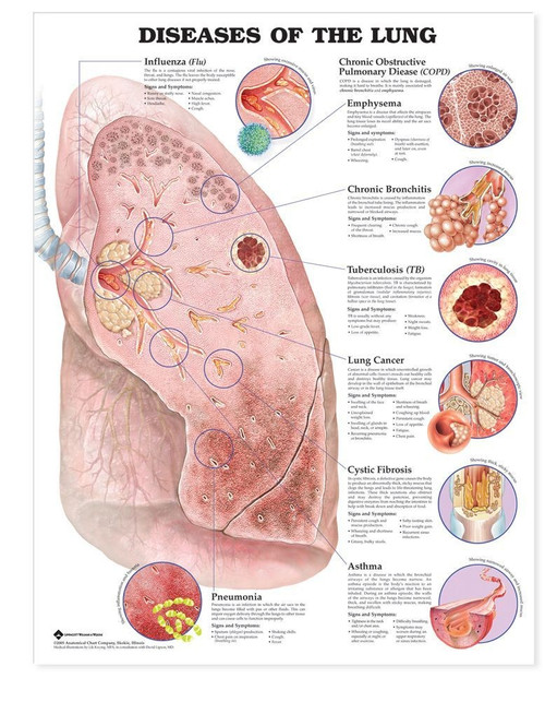 Diseases of the Lung Anatomical Chart