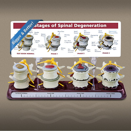 Spinal Model of Degeneration