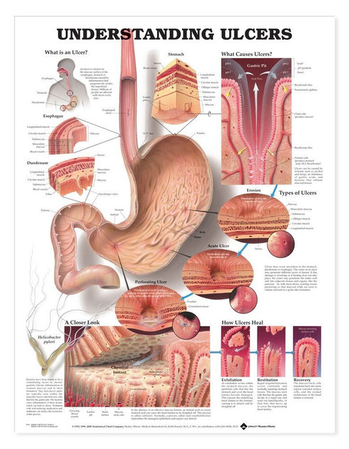 Understanding Ulcers Chart