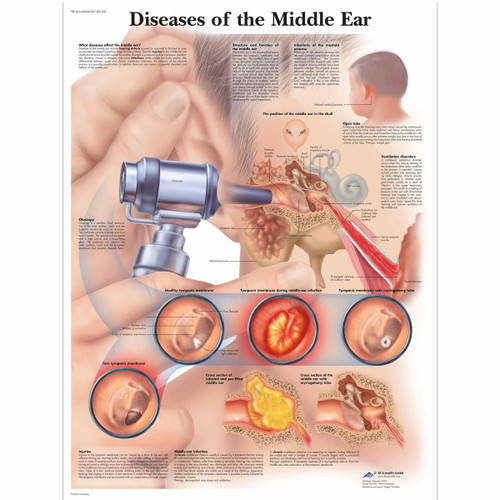 Ear Anatomical Poster Diseases of the Middle