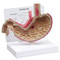 Stomach Ulcer Model