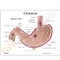 Stomach Ulcer Model Description Card