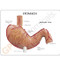 Stomach Ulcer Model Description Card