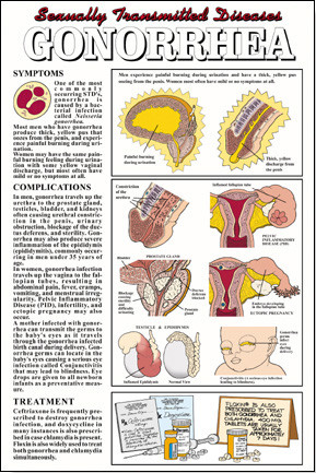 presentation of gonorrhea