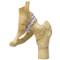 Arthritic Hip ,4-Stage Model