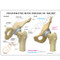 Arthritic Hip ,4-Stage Model Description Card